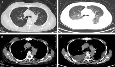 Pleural cryptococcosis diagnosed by pleural biopsy in an immunocompromised patient: a case report